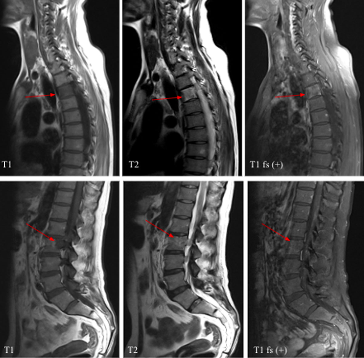 hodgkins lymphoma radiology