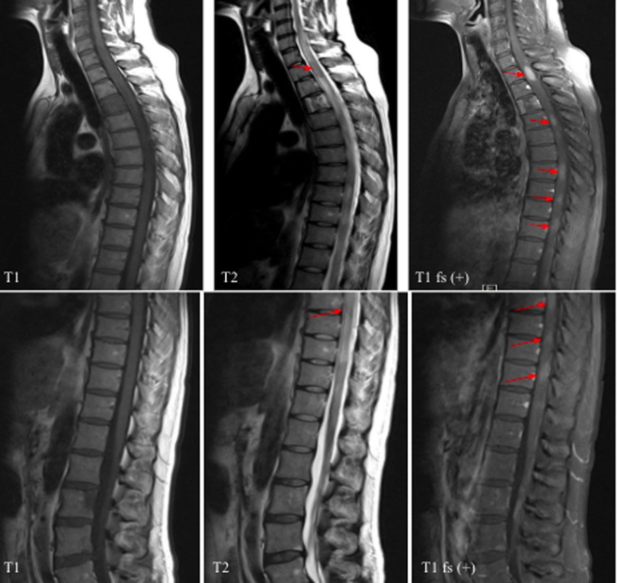 hodgkins lymphoma radiology