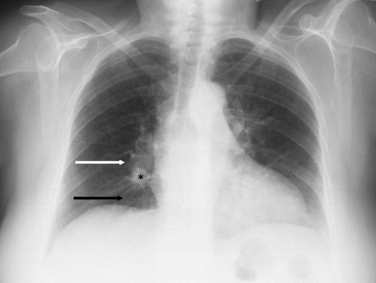 Pulmonary Embolism Chest X Ray