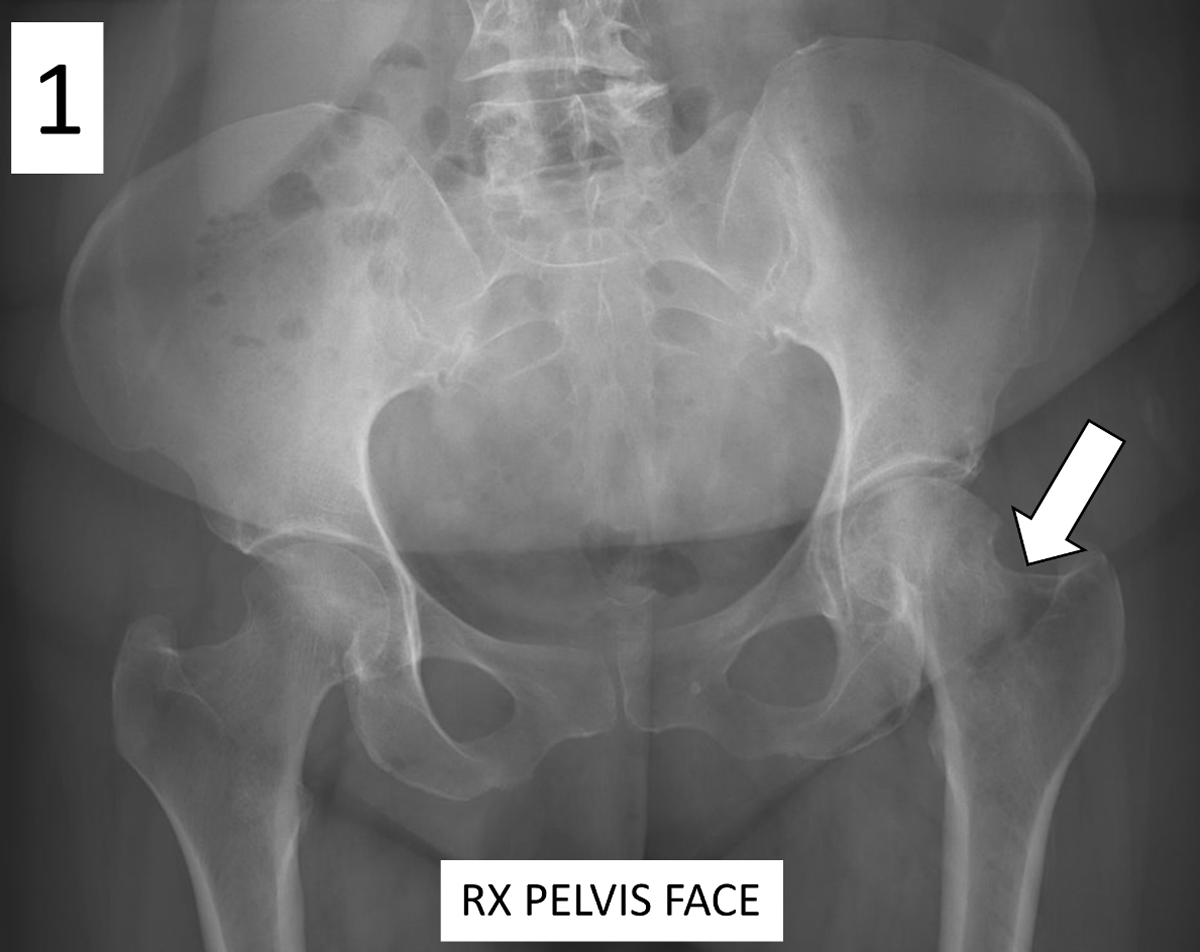 chondrosarcoma x ray