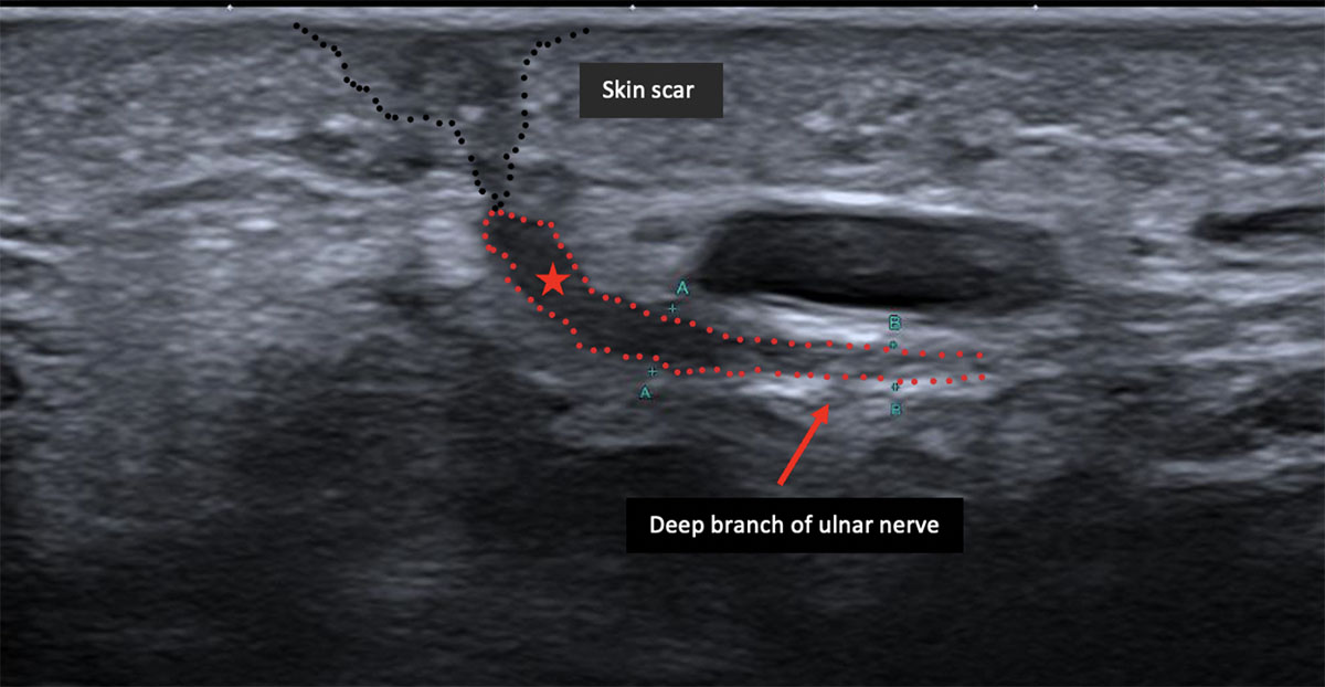 Deep Branch of Ulnar Nerve