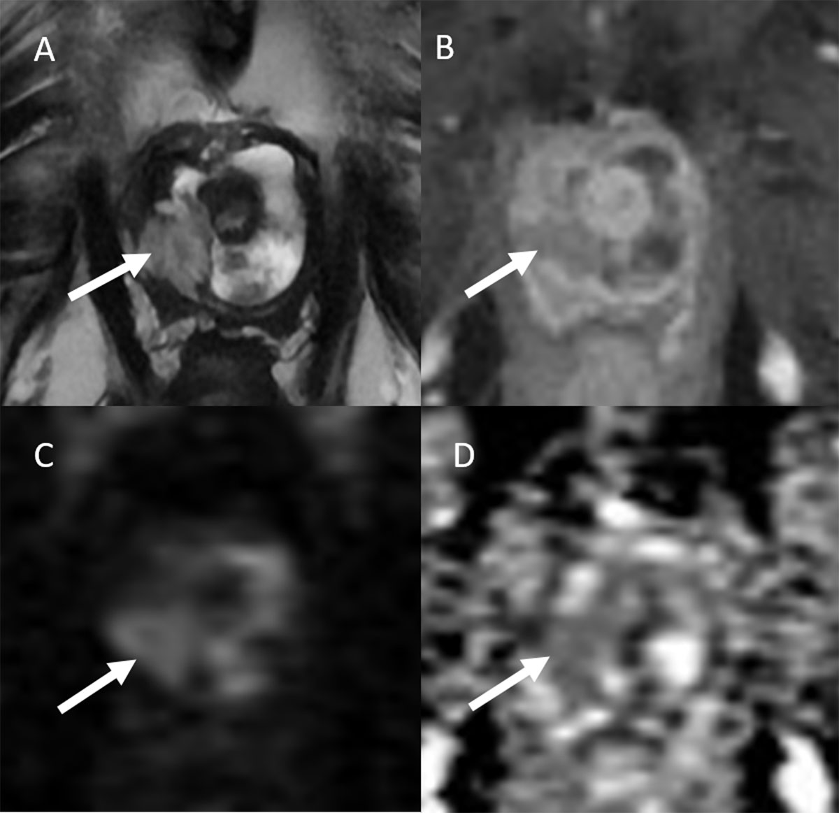 urethral diverticulum ultrasound