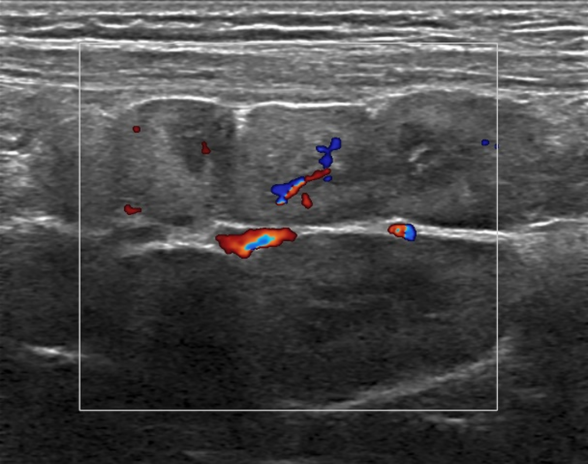 Gaucheroma of Mesenteric Lymph Nodes and Their Ultrasound Gaucheroma of Mesenteric Lymph Nodes and Their Ultrasound