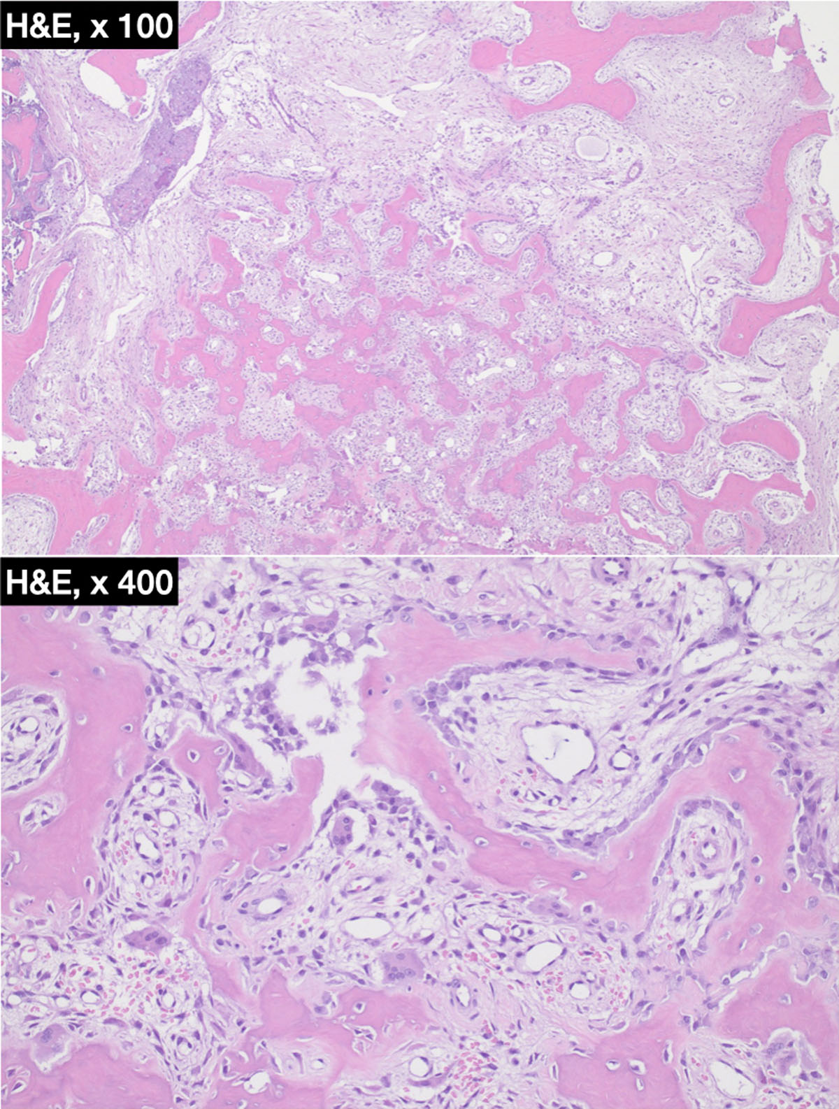 osteoid osteoma histology