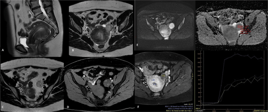 A Rare Presentation of Polypoid Endometriosis of the Douglas Pouch ...