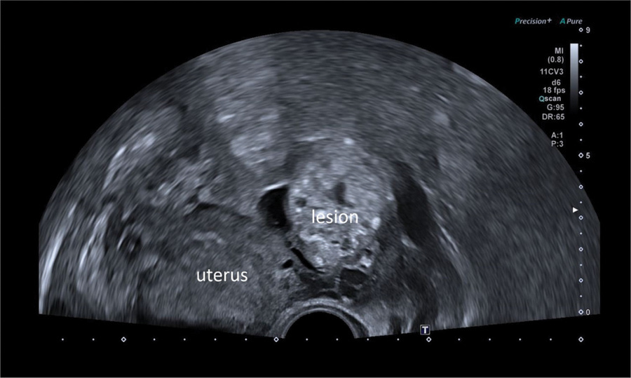 A Rare Presentation of Polypoid Endometriosis of the Douglas Pouch ...