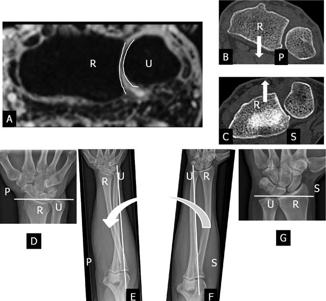 Imaging Findings of the Distal Radio-Ulnar Joint in Trauma - Journal of the  Belgian Society of Radiology