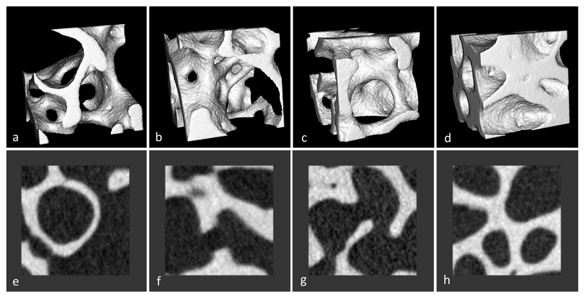 Examples of bone images with different forms and trabecular thickness