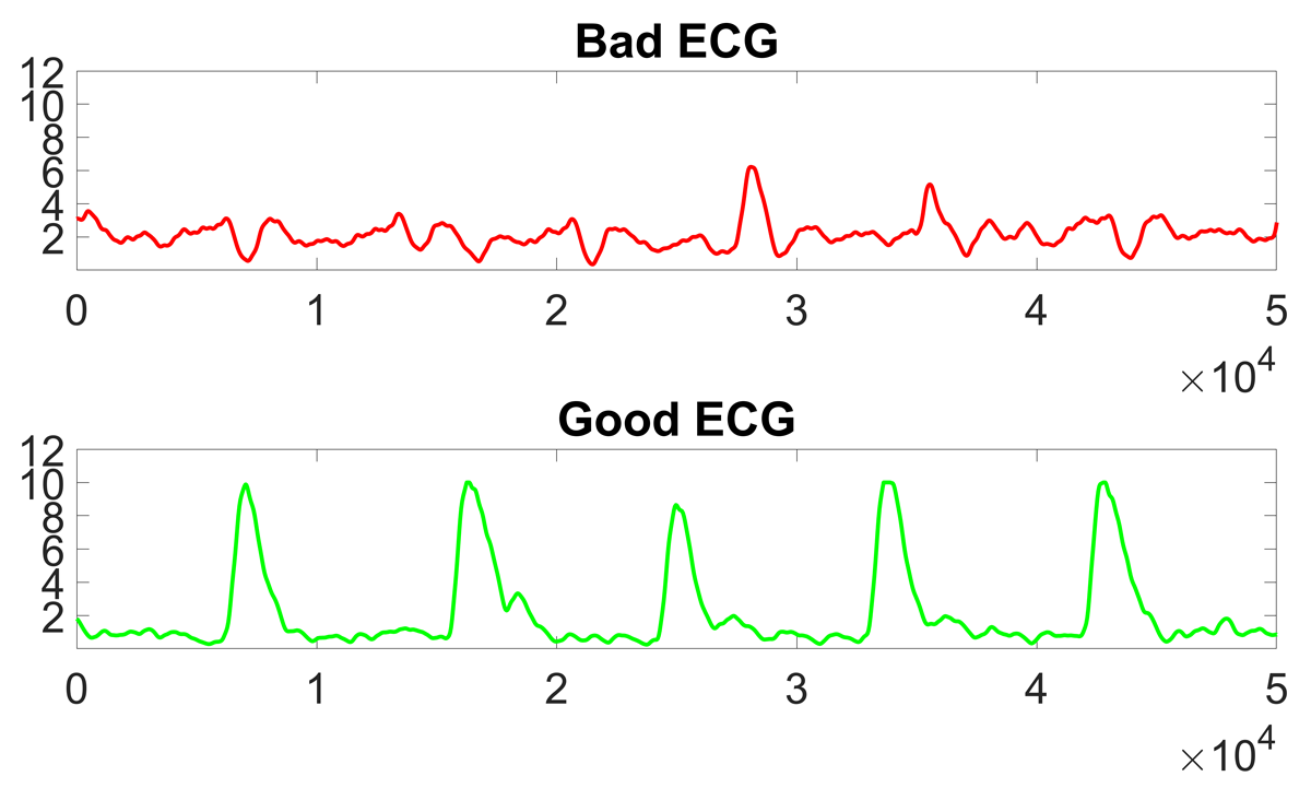 ECG inside the MRI scanner. All things being equal, participants’ compliance and preparation determine the legibility of the ECG’s R-waves used in the cardiac cycle manipulation. The figure shows the ECG of a participant who did not comply with the researcher’s instructions (top) and another one who did (bottom).