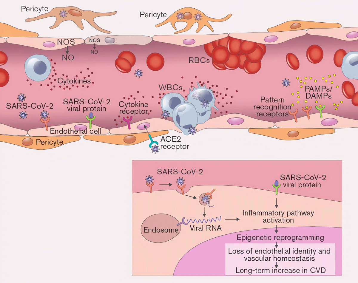 Endothelial cell infection and endotheliitis in COVID-19 - The Lancet