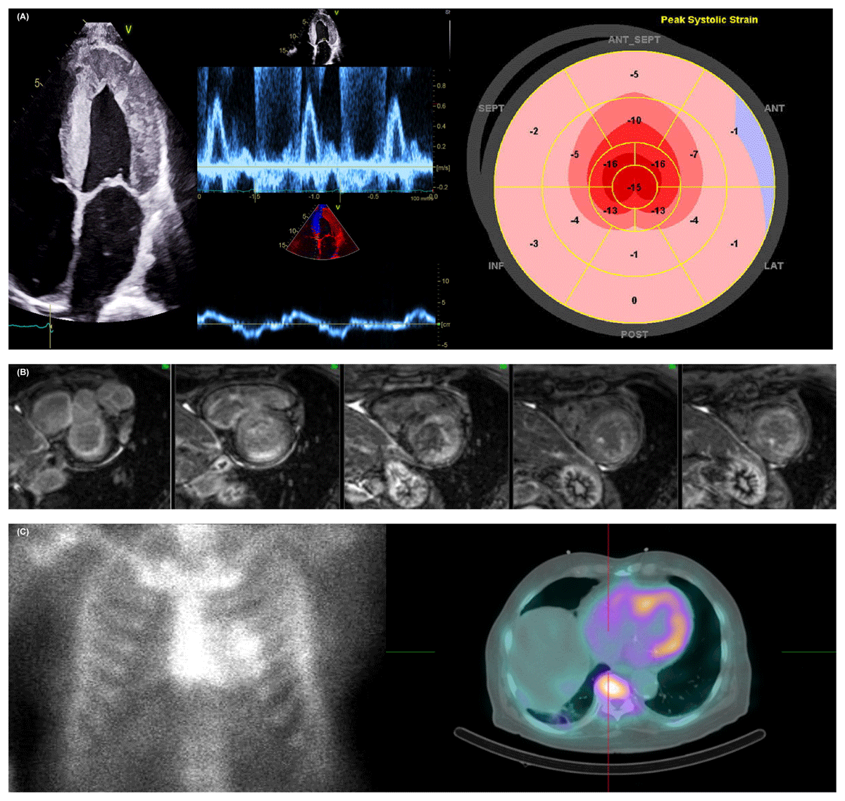 Relative apical sparing of longitudinal strain using two-dimensional  speckle-tracking echocardiography is both sensitive and specific for the  diagnosis of cardiac amyloidosis