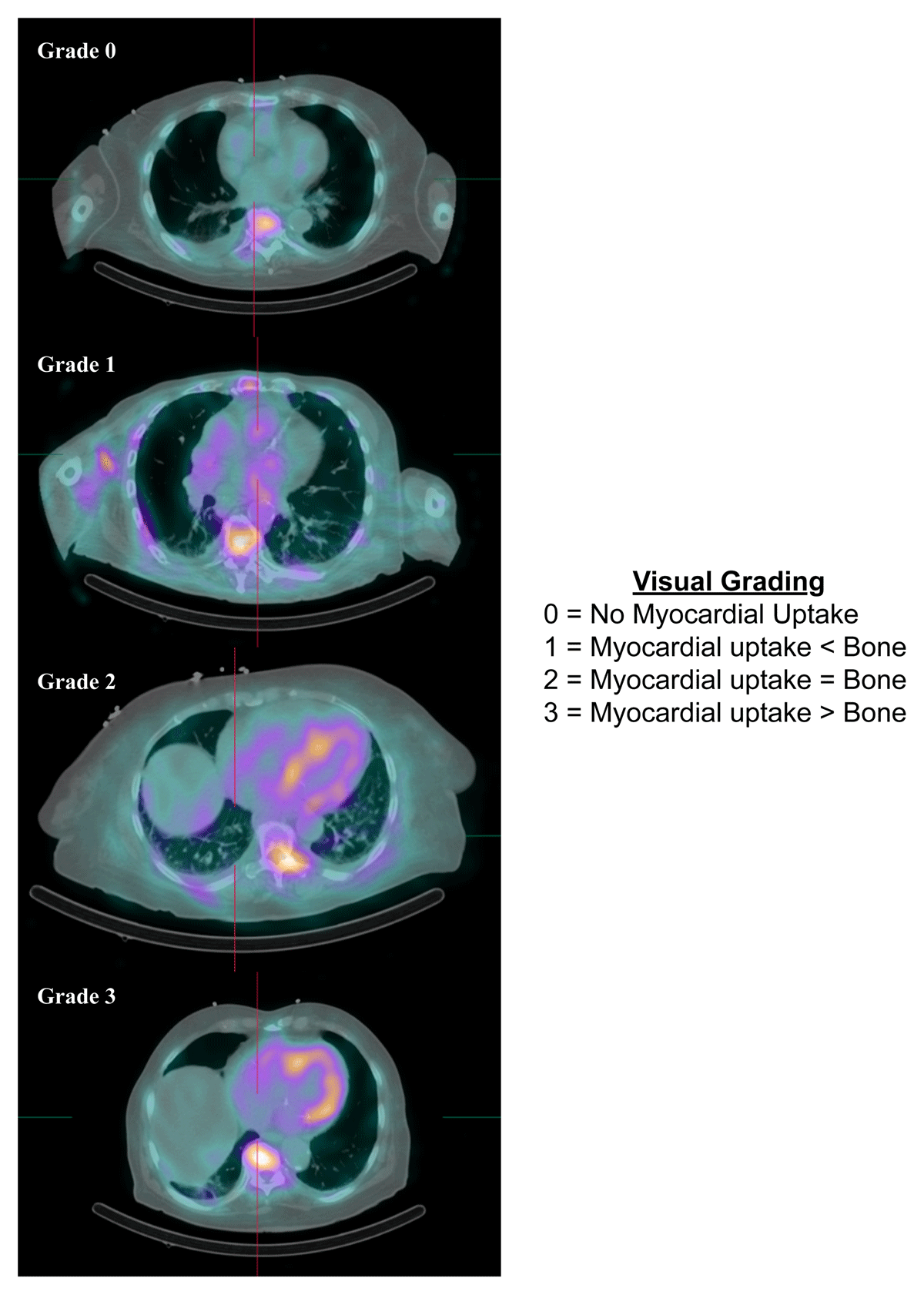 Cardiac amyloidosis: the value of myocardial strain