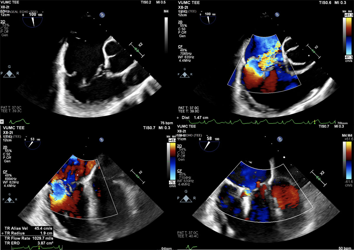 Multi-Modality Imaging of the Tricuspid Valve: From Tricuspid Valve Disease  to Catheter-Based Interventions