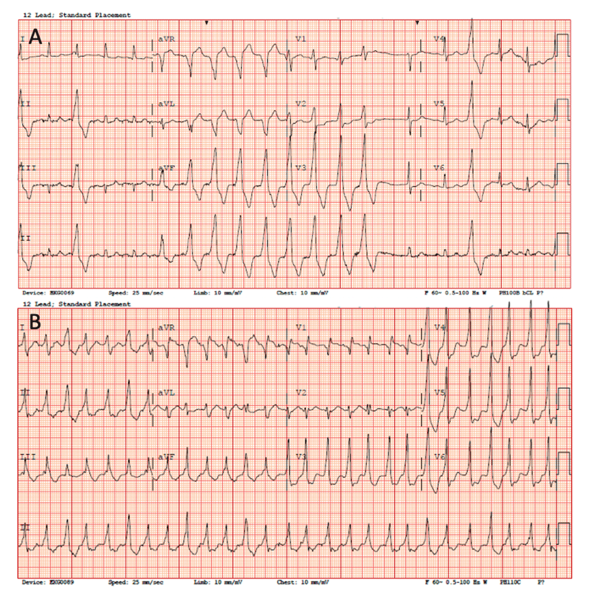 Delayed Total Atrioventricular Block After Transcatheter Aortic Valve  Replacement Assessed by Implantable Loop Recorders