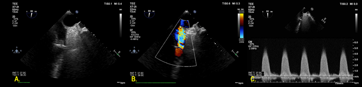 Illustration showing the transjejunal approach procedure. (A)... | Download  Scientific Diagram