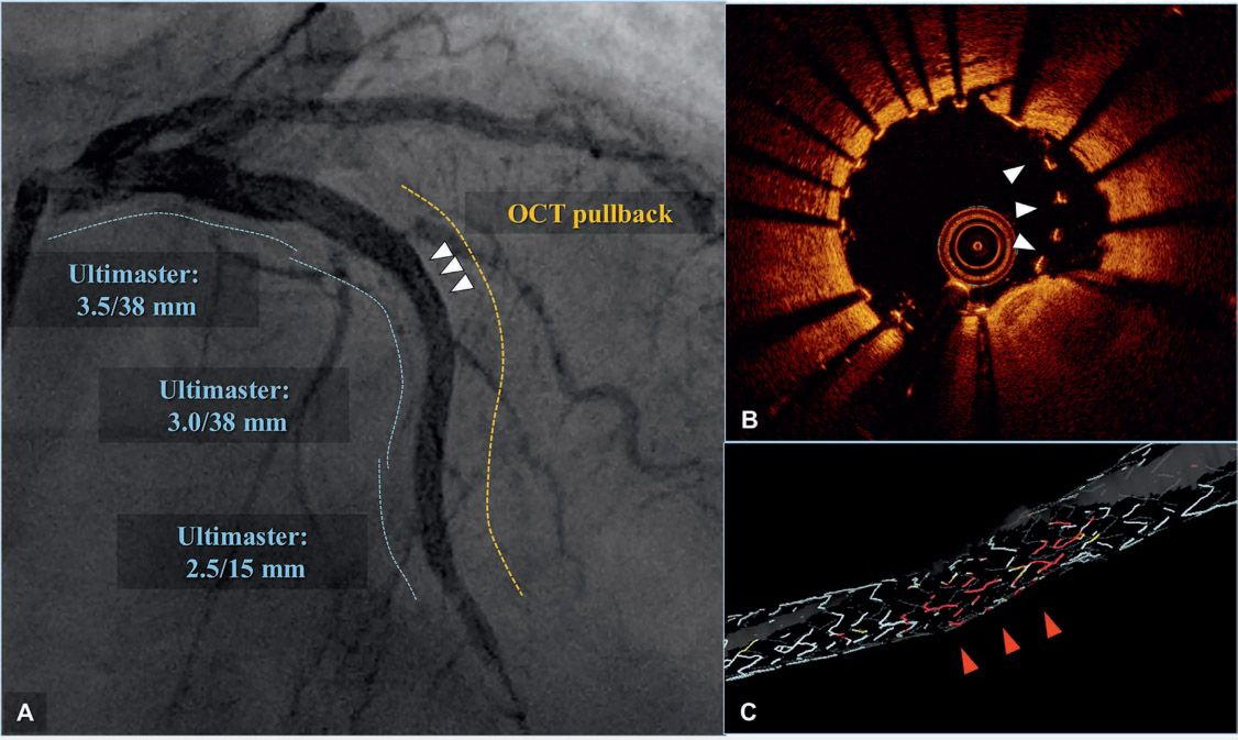 IVUS of SCAOL. The two arrows point to the internal elastic