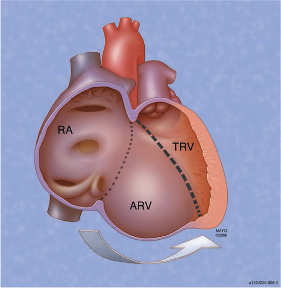 Braz J Cardiovasc Surg - Mitral annulus morphologic and functional analysis  using real time tridimensional echocardiography in patients submitted to  unsupported mitral valve repair