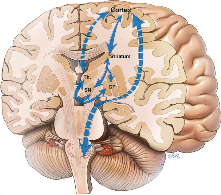 Fig 2.  Subcortical Volumetric Reductions in Adult Niemann-Pick