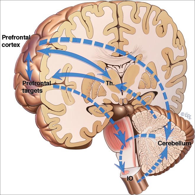 Fig 2.  Subcortical Volumetric Reductions in Adult Niemann-Pick