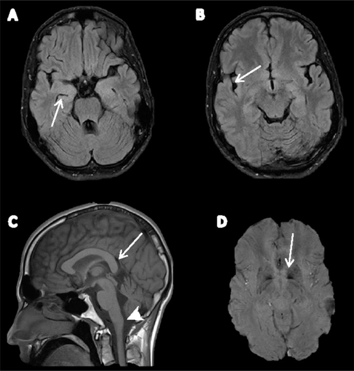 PLA2G6-associated Dystonia–Parkinsonism: Case Report and 