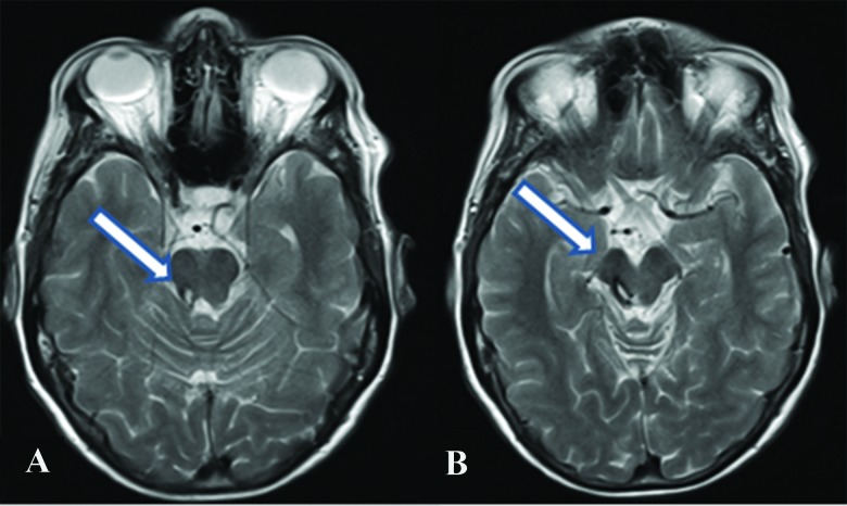 cerebellar peduncle mri