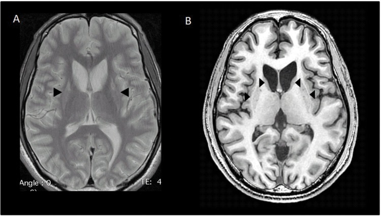 generalized dystonia