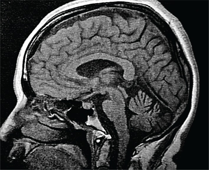 cerebellar vermis atrophy