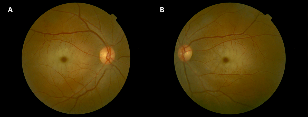 Cherry-Red Spot in Tay–Sachs Disease