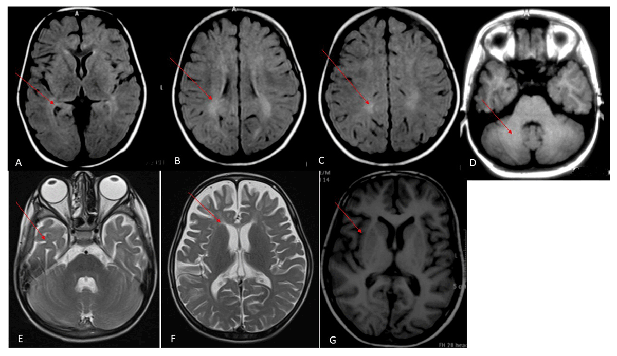 Patient with Niemann-Pick disease type C: over 20 years' follow-up