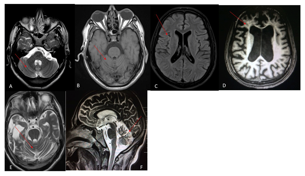 Patient with Niemann-Pick disease type C: over 20 years' follow-up