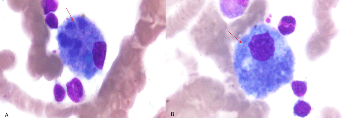 Diagnostic and predictive methods for a Niemann-Pick disease type