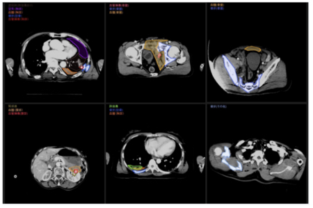 The ERATS uses AI to swiftly analyze whole-body CT scans. &nbsp; &nbsp; Source Fcuro<br>