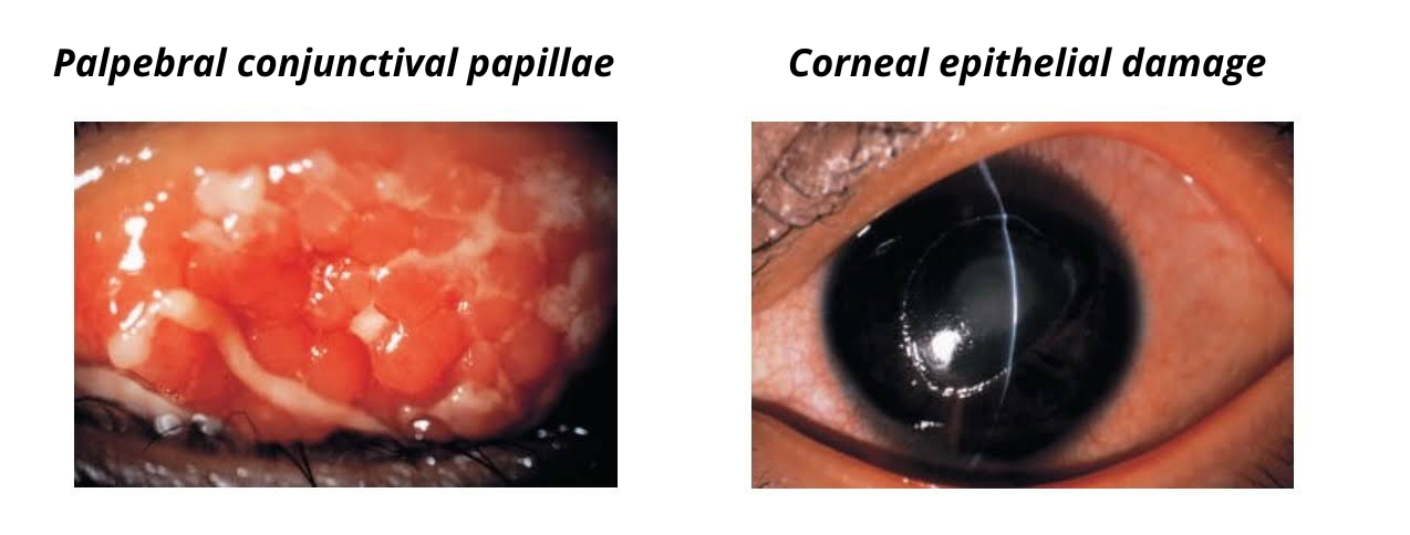 Atopic keratoconjunctivitis causes not only severe eye itching and redness, but in advanced cases can involve conjunctival overgrowth and corneal damage, sometimes leading to blindness &nbsp; &nbsp; &nbsp; &nbsp; All photos courtesy of Saga University, Department of Molecular Life Science (translated by JStories)