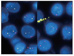 ■脳腫瘍組織での遺伝子領域のGain/Loss解析
ターゲットを黄色、リファレンスを赤色にプローブを設計しFISHを行った結果、腫瘍領域(左)ではターゲット領域のLossが
確認された。右は正常領域。