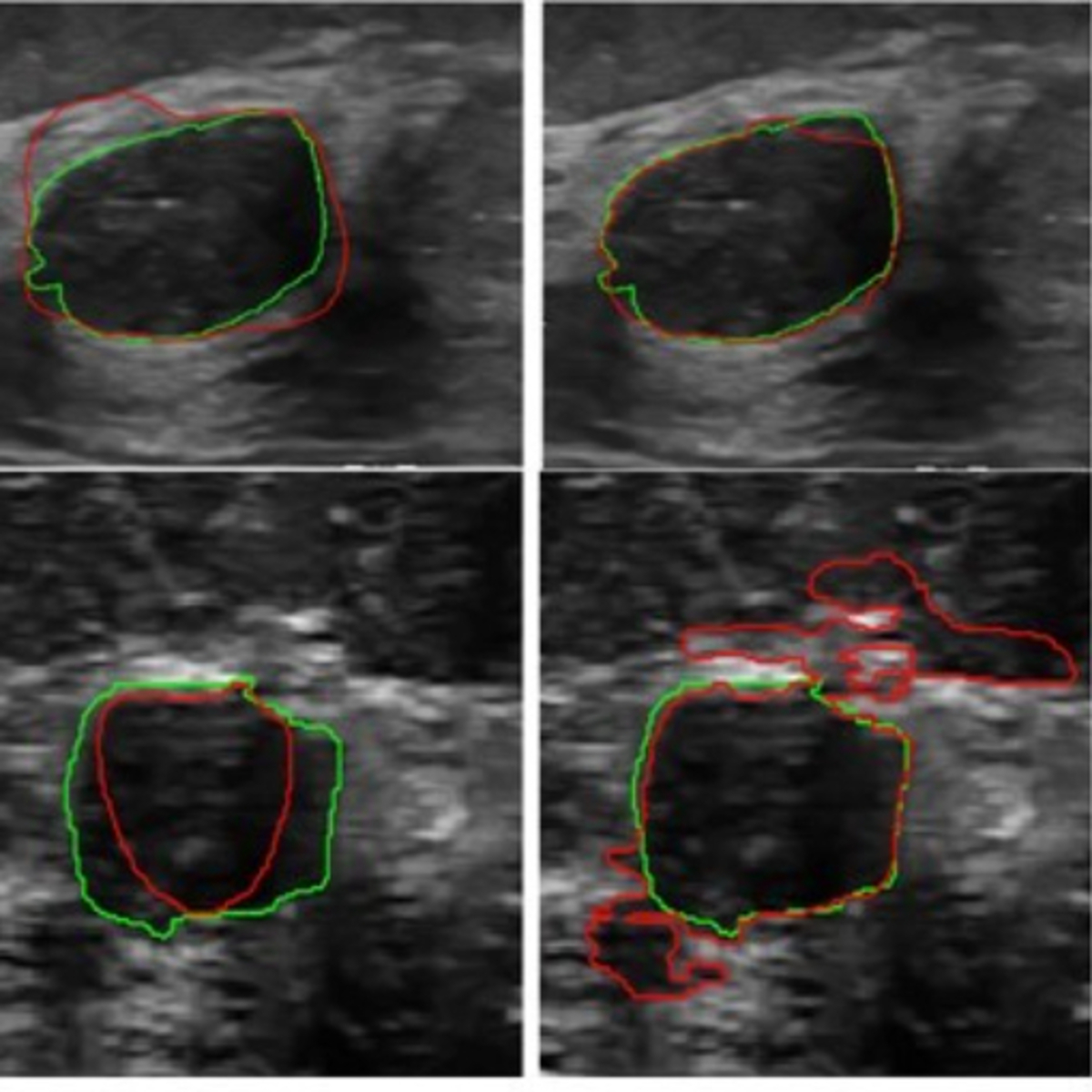 Breast Ultrasound Images Dataset Kaggle