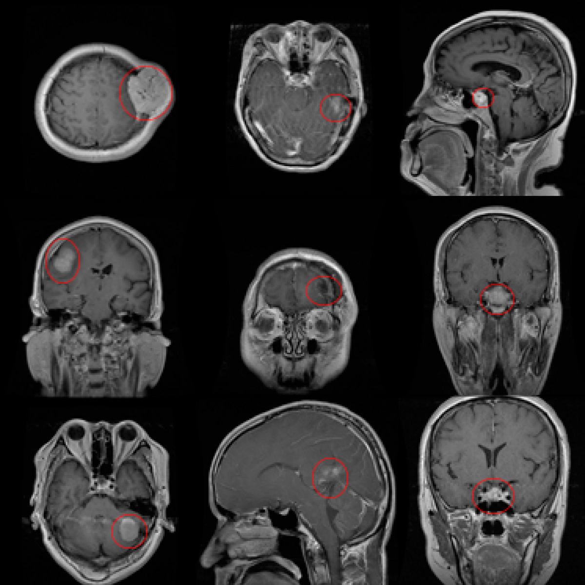 Brian Tumor Dataset | Kaggle