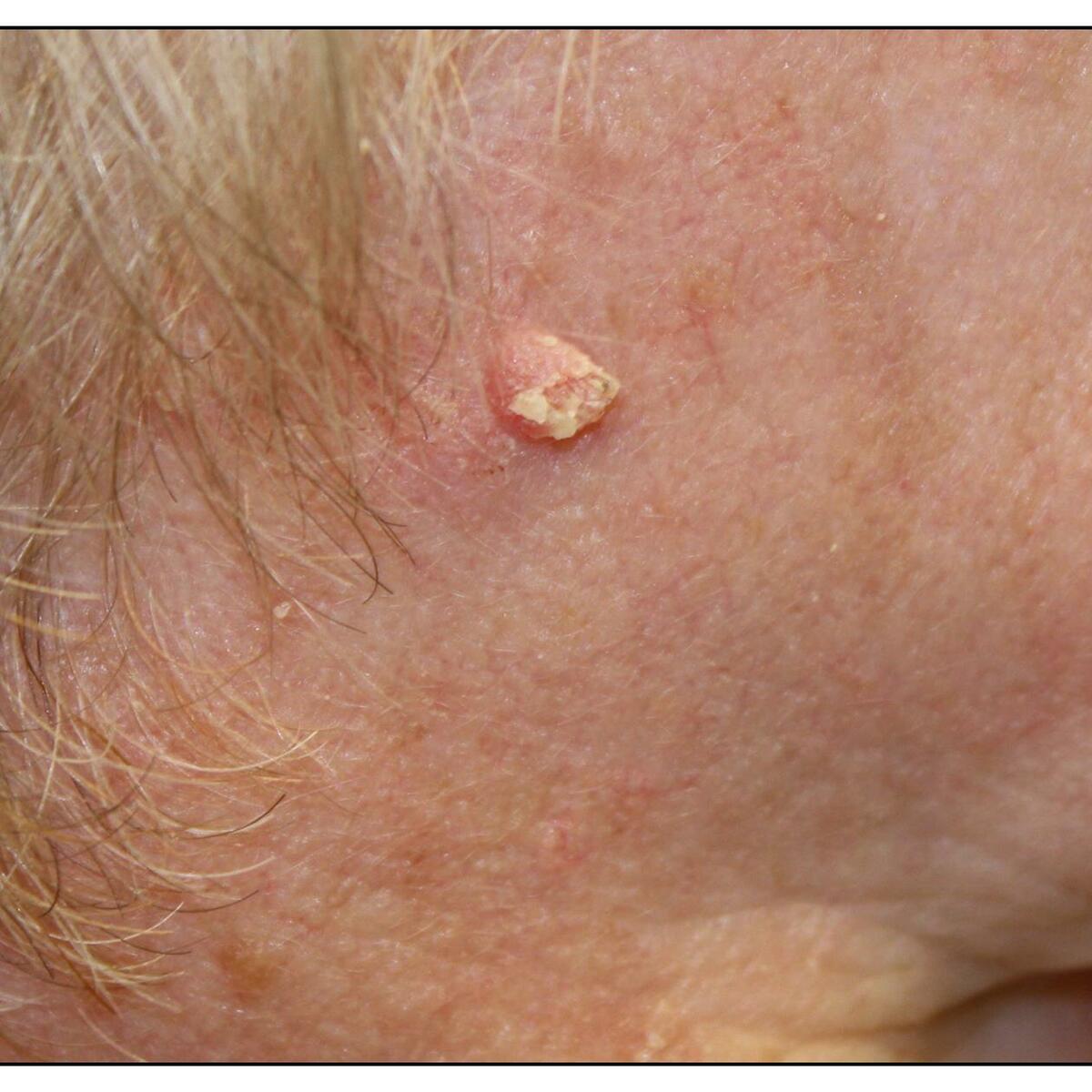 Skin Cancer Malignant Vs Benign Kaggle