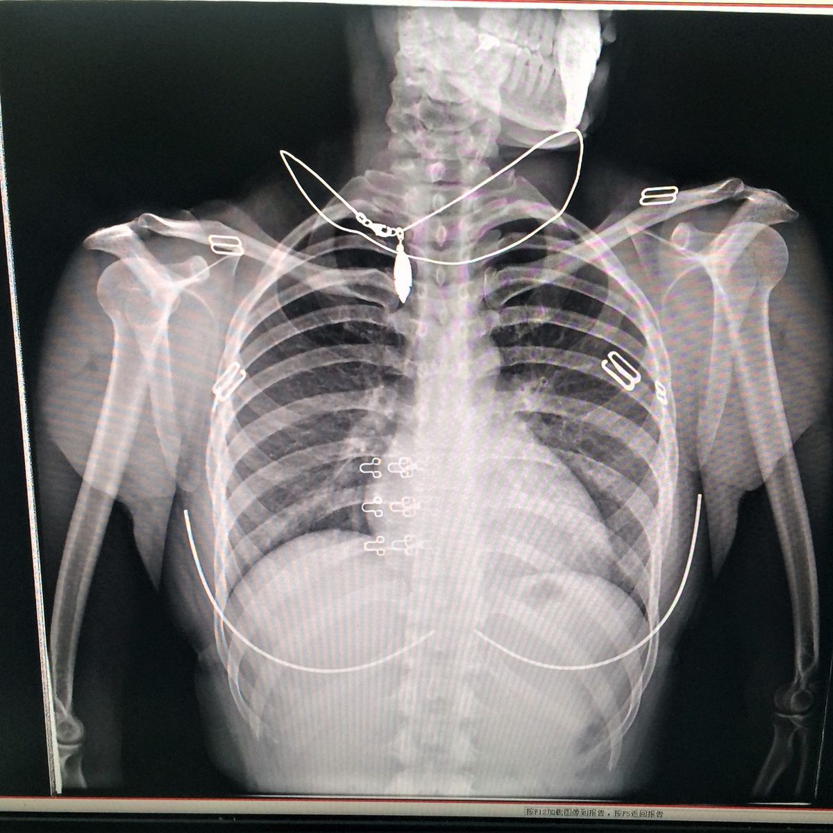 bronchopneumonia chest x ray