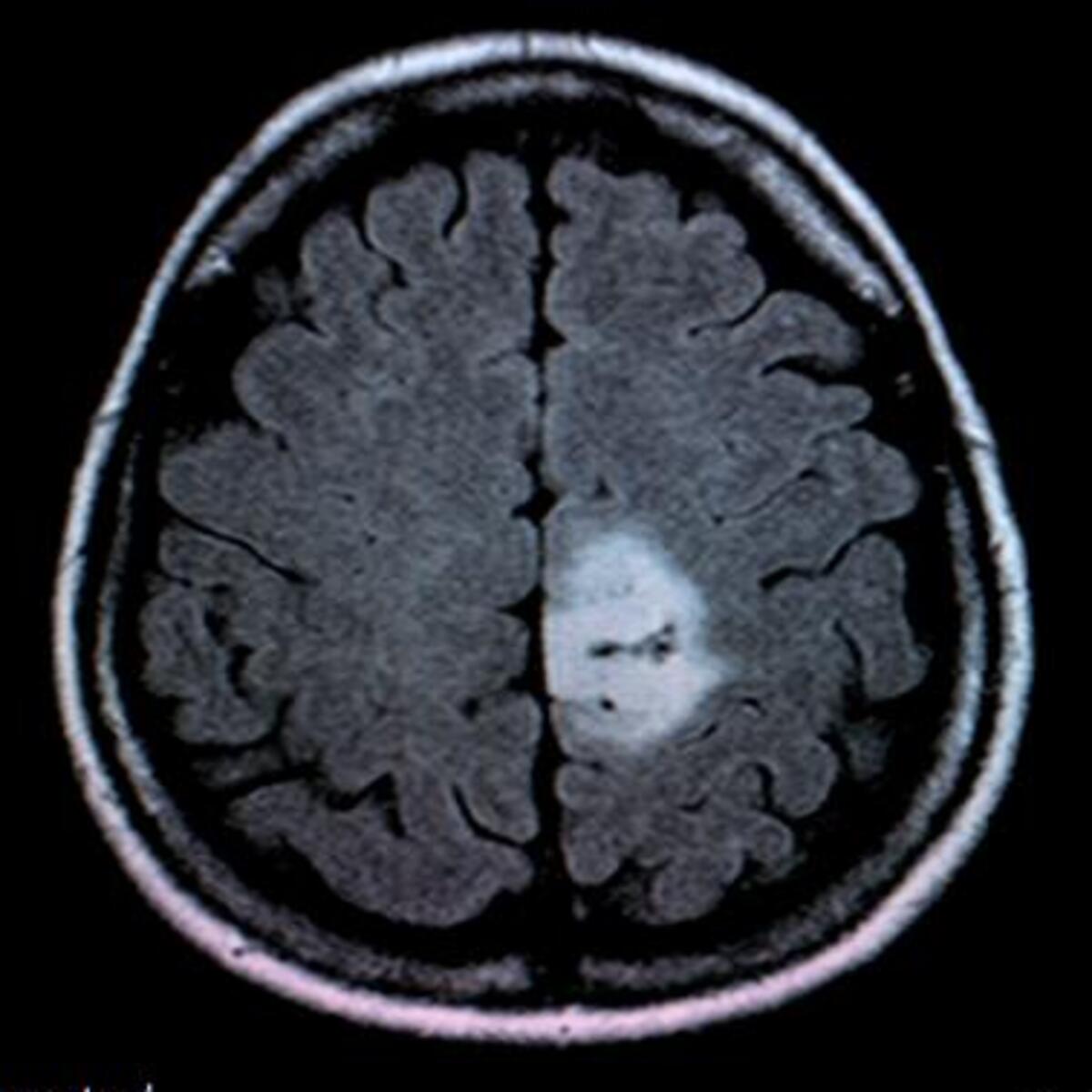 brain-tumor-mri-image-classification-kaggle