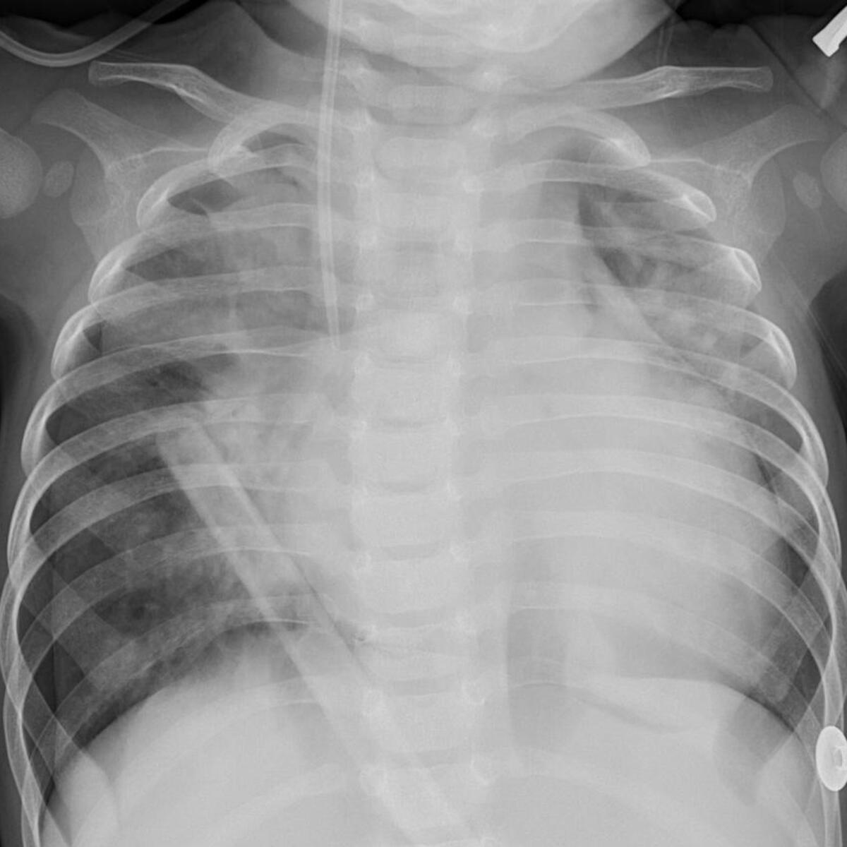 [BEGINNER] Chest XRay Image Classification Kaggle