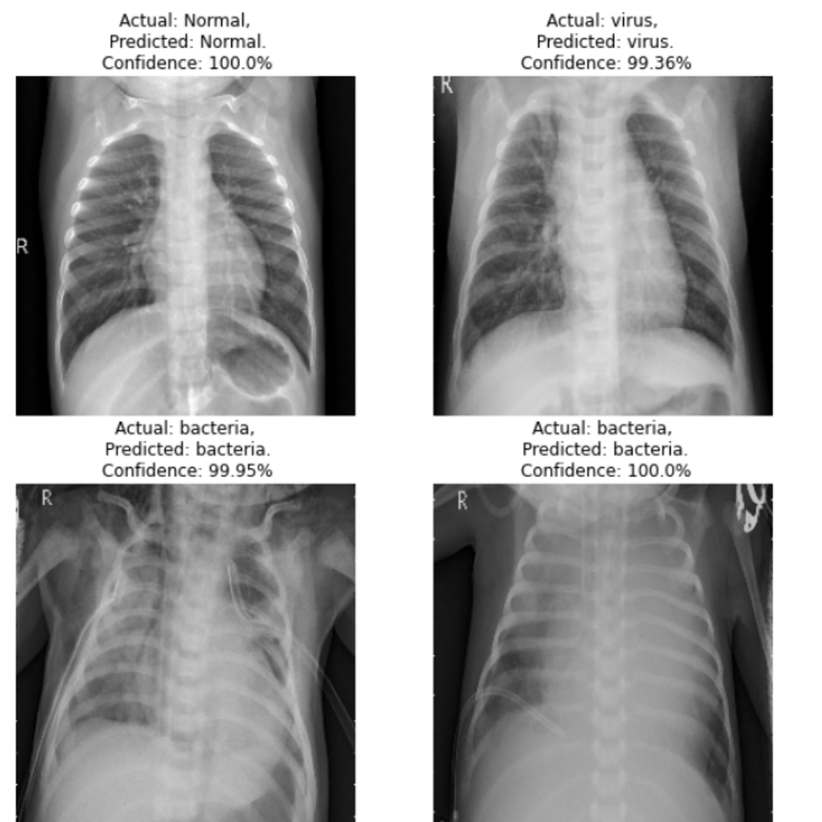 Chest XRay Images (Pneumonia) with new class Kaggle