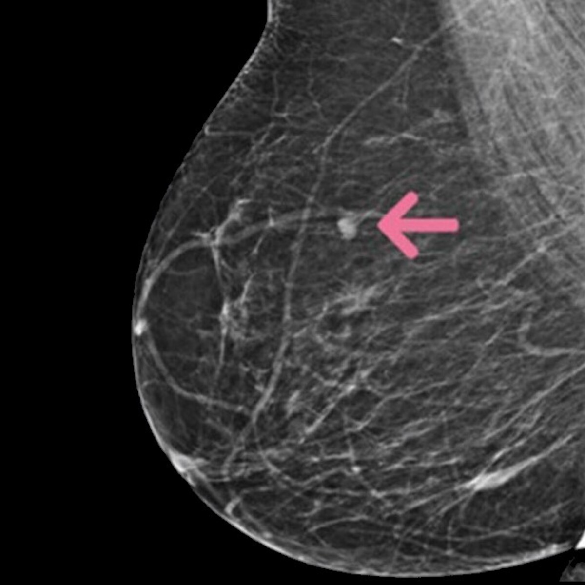 breast-cancer-ct-fully-preprocessed-kaggle