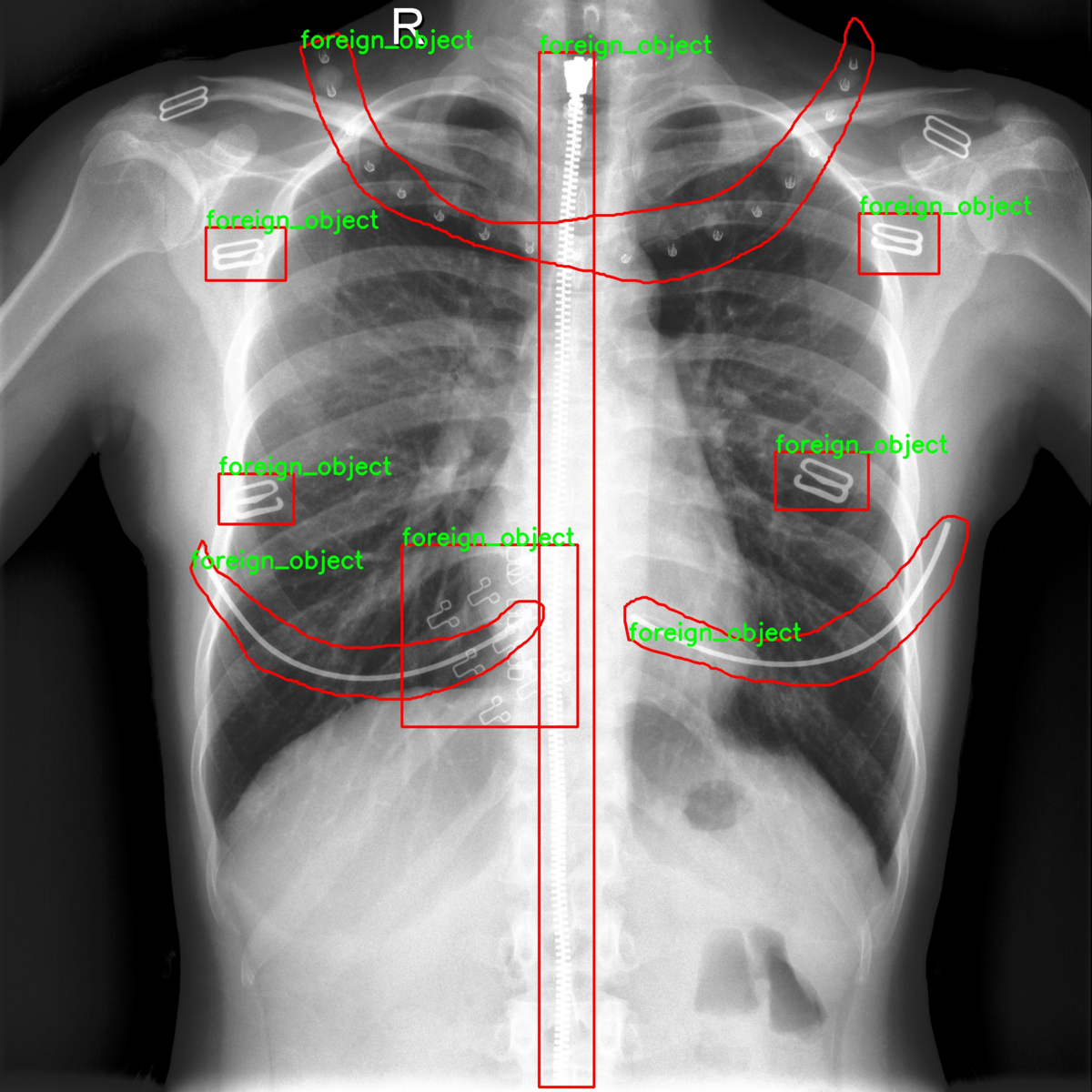 Foreign objects in chest X-rays