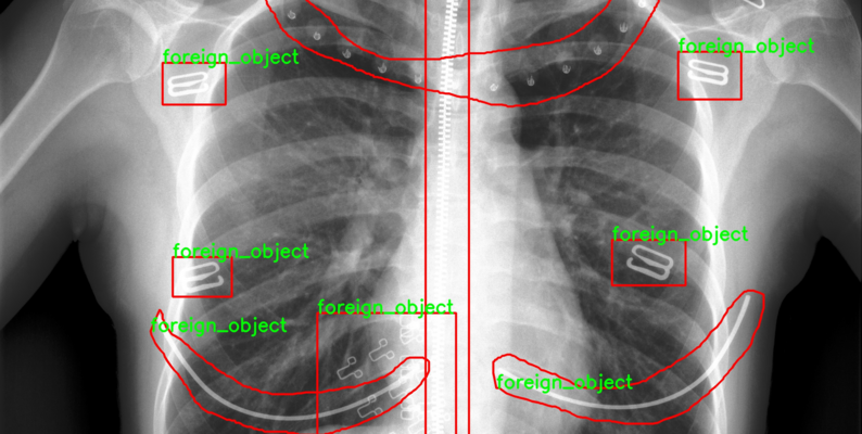 Foreign objects in chest X-rays