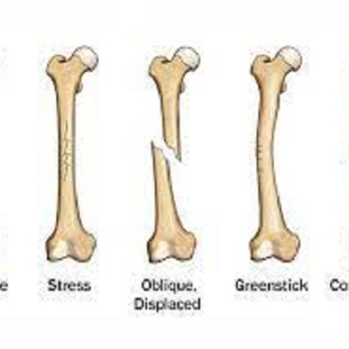 Поставить на 4 кости. Типы переломов трубчатых костей. Переломы трубчатых костей.