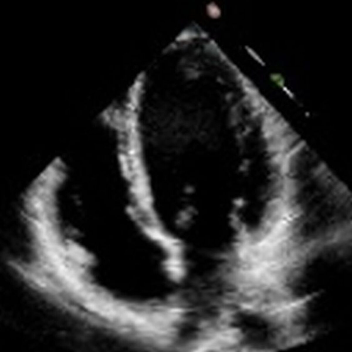 EchoNet-Dynamic Cardiac Ultrasound