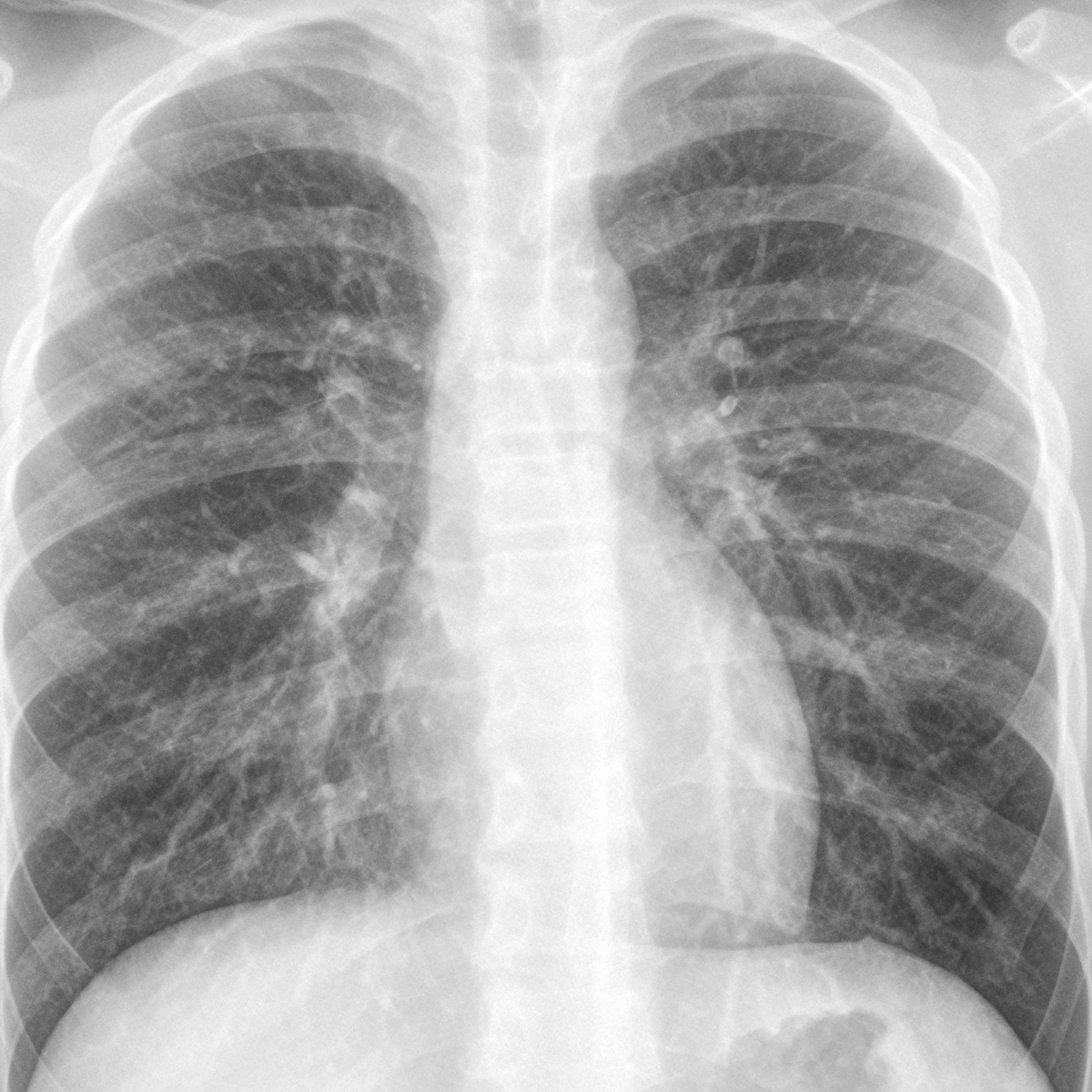 bronchopneumonia x ray findings
