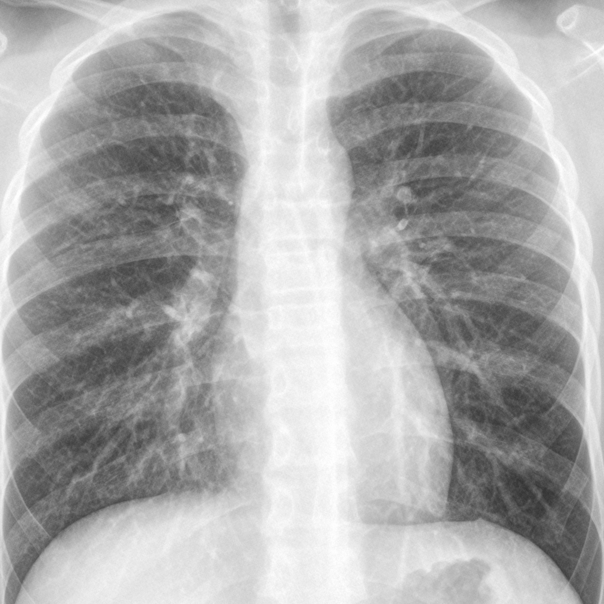 walking pneumonia chest x ray findings