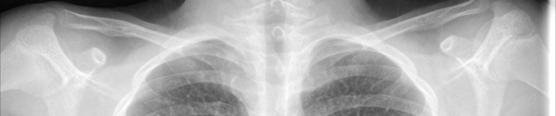 bacterial pneumonia chest x ray findings