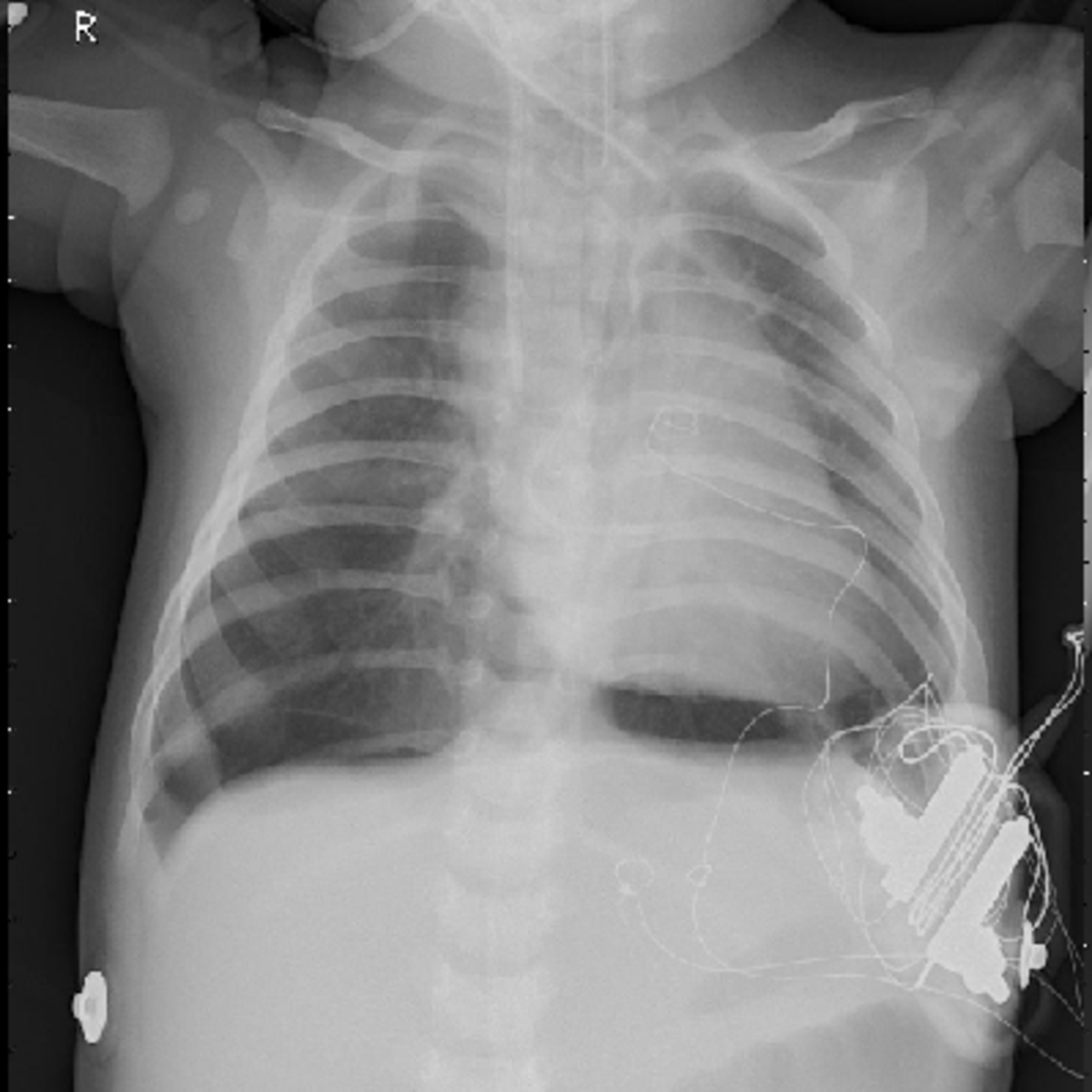 walking pneumonia chest x ray findings